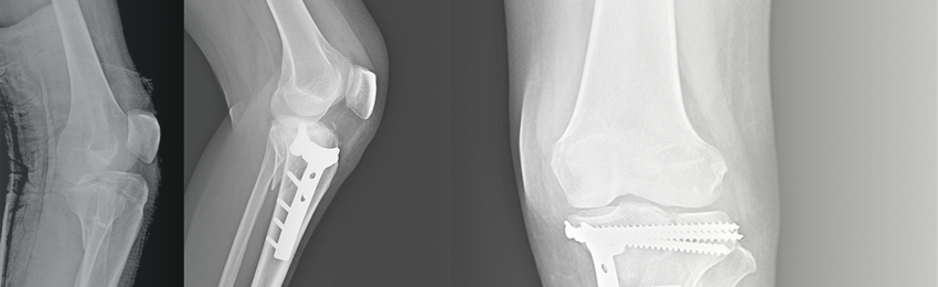 x-ray-of-knee